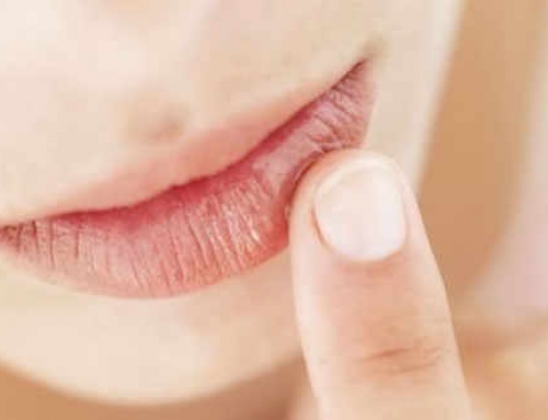 Herpes labial