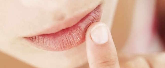 herpes-labial