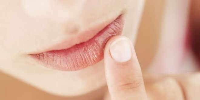 herpes-labial