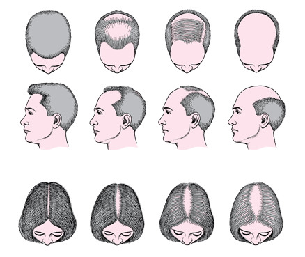 alopecia