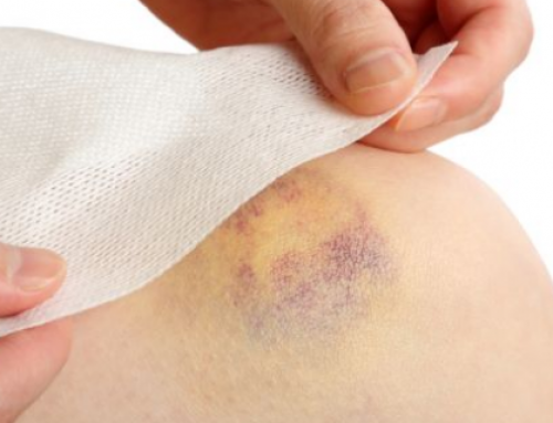Golpes y Hematomas