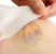 golpes-y-hematomas