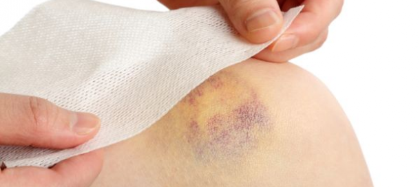 golpes-y-hematomas