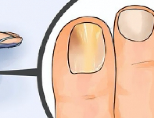 Hongos en las uñas